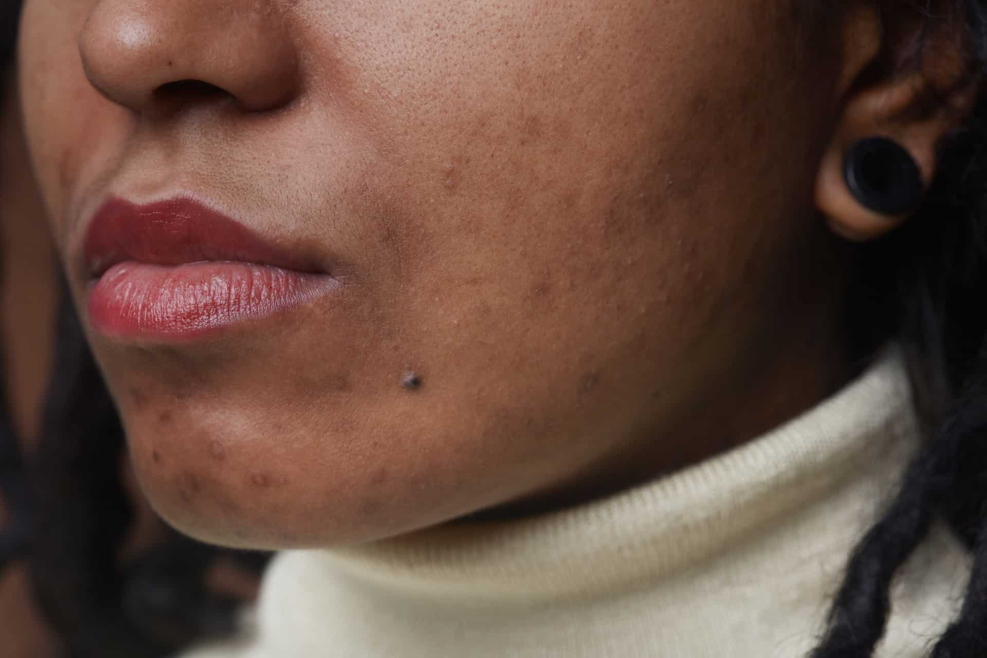 Image of Acne & Acne Scarring