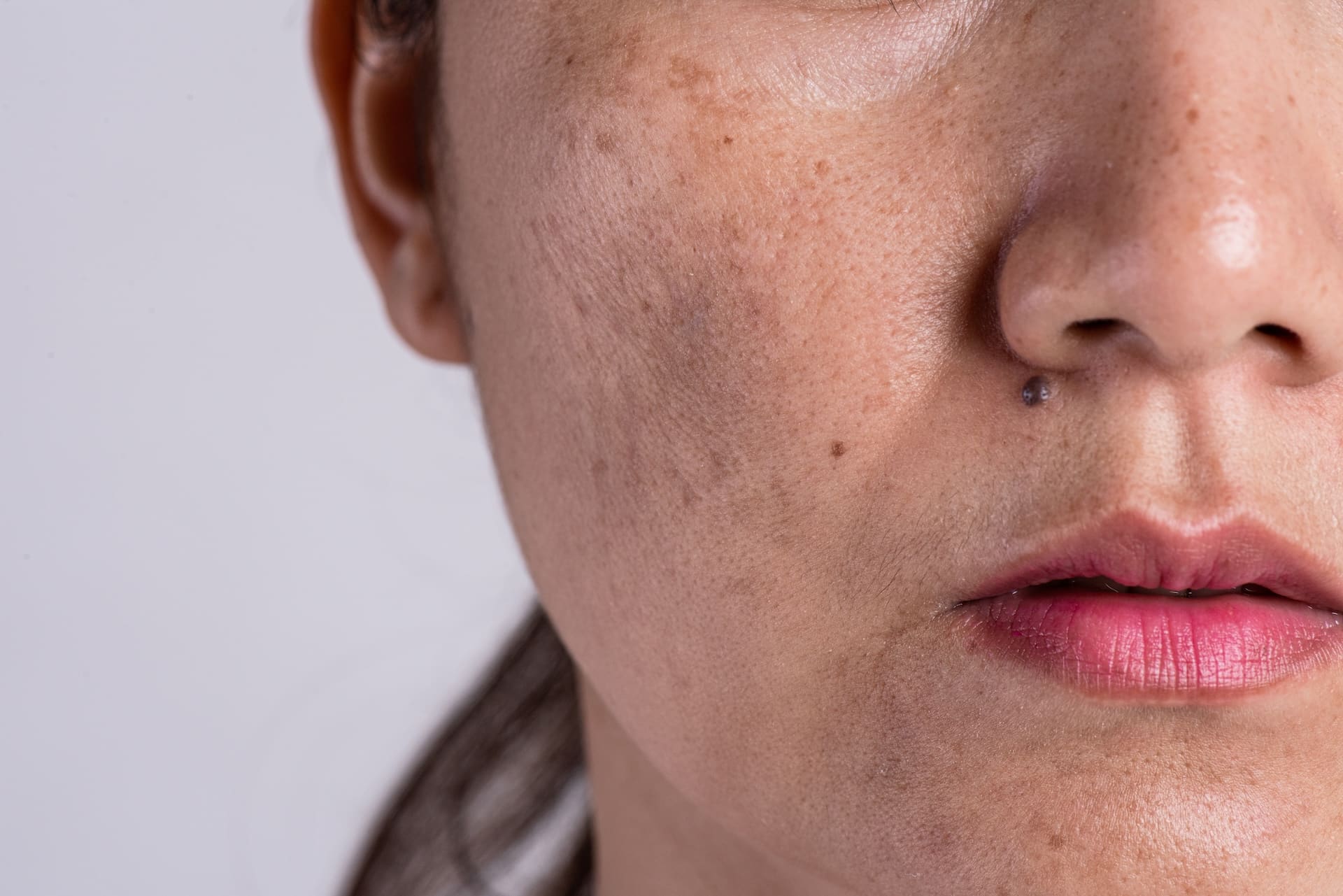 Image of Uneven Skin Texture & Dullness