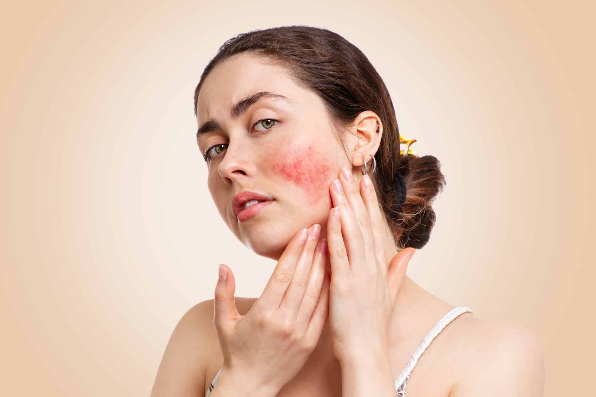 Image of Rosacea