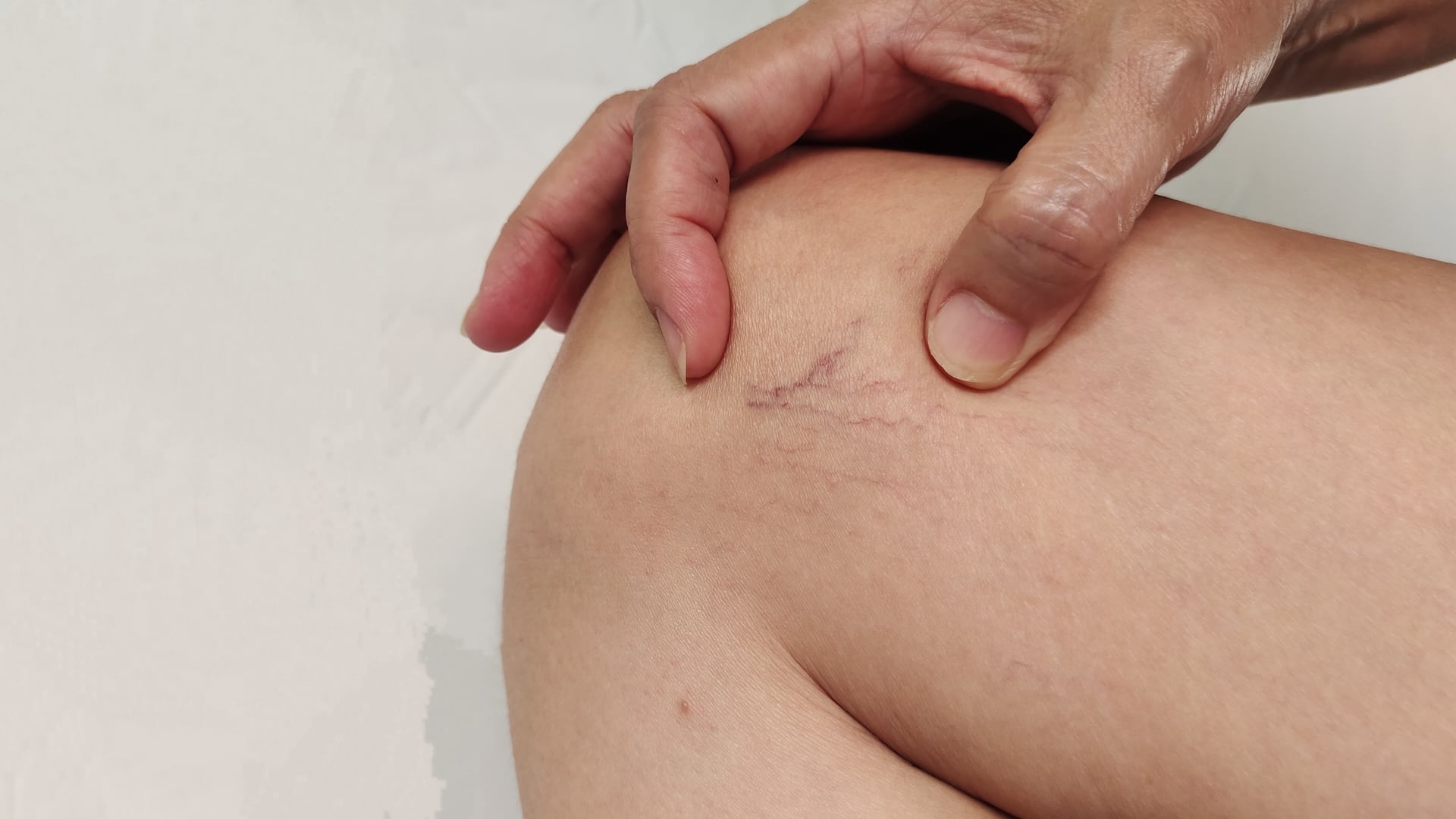 Image of Varicose & Spider Veins