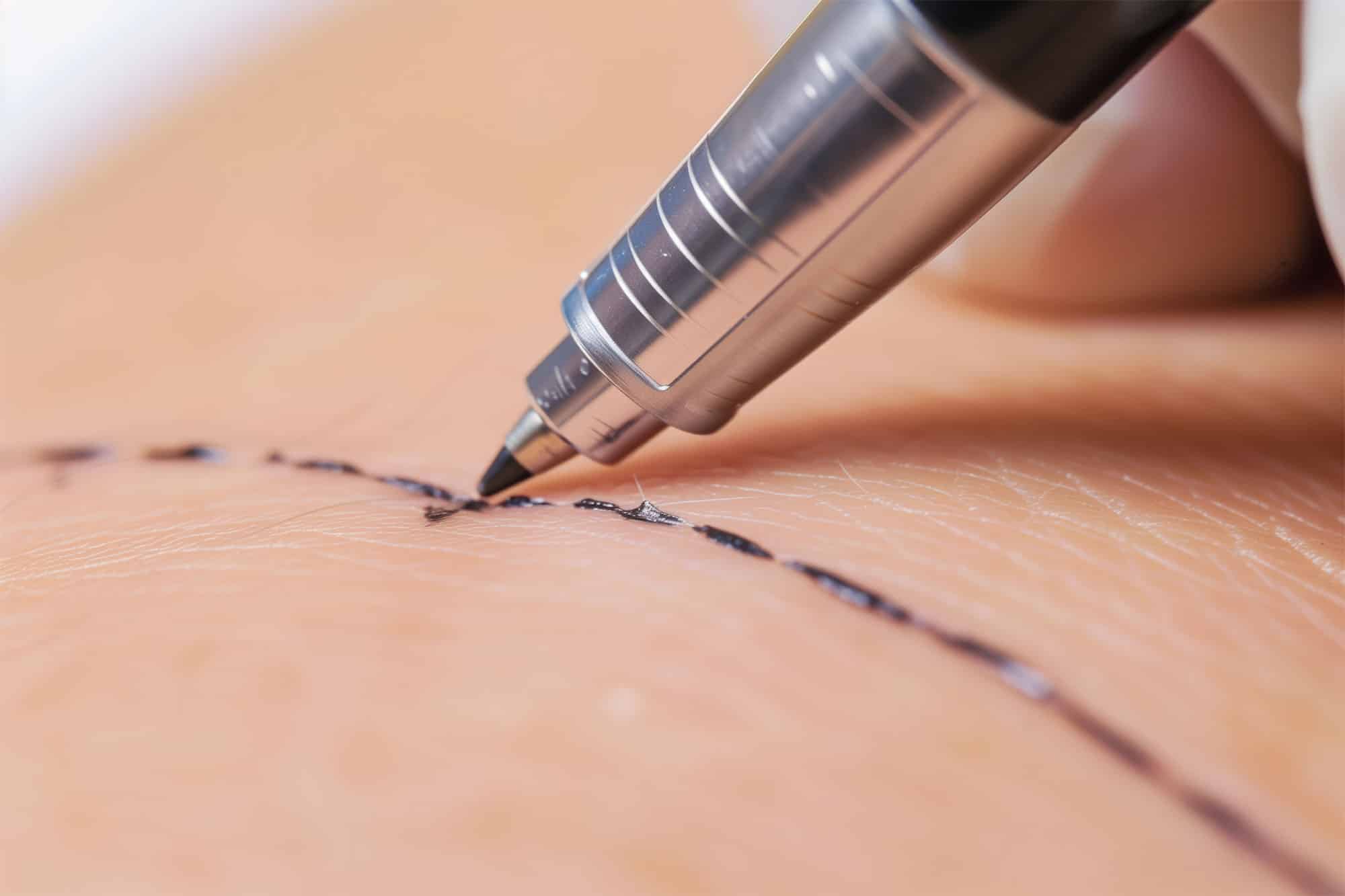 Image of Surgical Excision